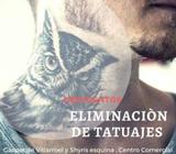 Eliminacion de Tatuajes