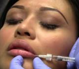 Aumento de Labios