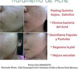 Tratamiento para el Acné