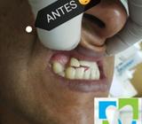 Protesis Dentales