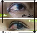 Cauterizacion de Lunares