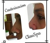 Electrocauterizacion de Lunares