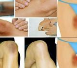 MANCHAS CORPORALES PEELING QUÍMICO
