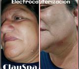 Cauterizacion
