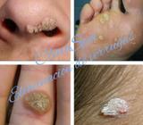 Cauterizacion de Verrugas