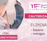 Cauterización de lunares, verrugas y carnosidades