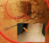 Electrocauterizacion de Lunares O Verrug