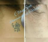 Eliminación de Tatuajes