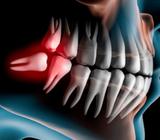 Cirugia Terceros Molares