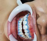 ACLARAMIENTO O BLANQUEAMIENTO DENTAL