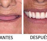PROTESIS TOTALES PARA PACIENTES SIN NINGUN DIENTE GRATIS